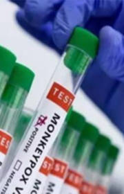 Karnataka reports first Mpox case this year as 40-year-old Dubai returnee tests positive Karnataka reports first Mpox case this year as 40-year-old Dubai returnee tests positive